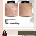 Benefits Of Microneedling- Derma One Clinic