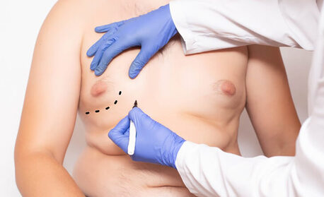 New Delhi, Health, Gynecomastia And Liposuction Surgery: Do You Need Both?