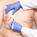 Gynecomastia And Liposuction Surgery: Do You Need Both?