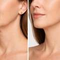 Ultherapy Dubai: A Complete Guide To Non-Surgical Skin Lifting & Tightening