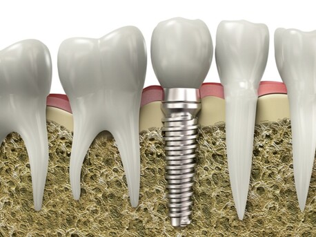 Washington DC, Health, Are Denture Implants Worth It?