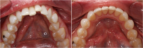 Dublin, Dental, Invisalign In Dublin For Clear & Comfortable Teeth Straightening | Dublin Metro Dental