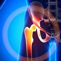 Restoring Mobility With Hip Replacement Surgery In Ahmedabad