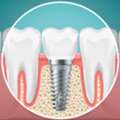 Dental Implant In Gurgaon &ndash; Safe & Long-Lasting Tooth Replacement