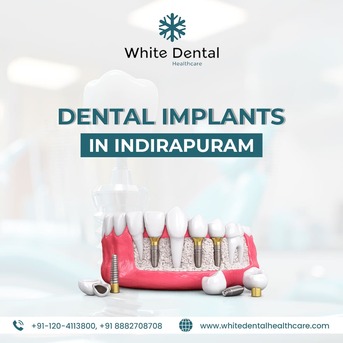 Mumbai, Dental, Dental Implants In Indirapuram For Healthy And Strong Teeth
