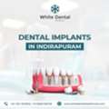 Dental Implants In Indirapuram For Healthy And Strong Teeth