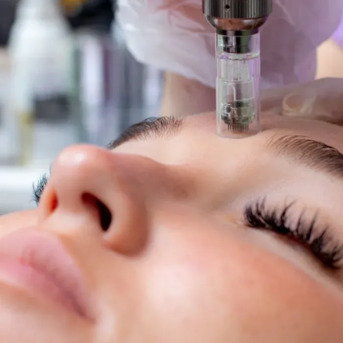 London, Beautician, Microneedling Treatment For Face In Kentish Town, Ldn