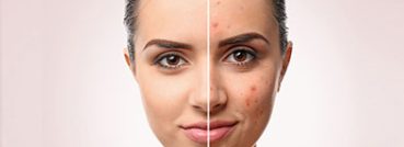New York, Health, Deep Clean Start For Breakout-Prone Skin
