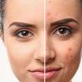 Deep Clean Start For Breakout-Prone Skin