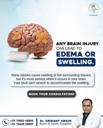 Bhubaneswar, Health, Brain Injury & Swelling (Edema) | Best Brain Surgeon In Bhubaneswar | Dr. Srikant Swain