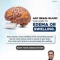 Brain Injury & Swelling (Edema) | Best Brain Surgeon In Bhubaneswar | Dr. Srikant Swain
