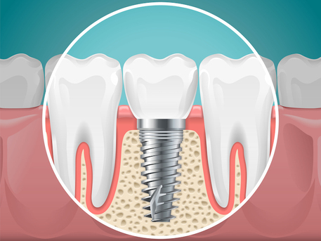 Gurgaon, Dental, Dental Implant In Gurgaon