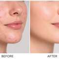 Acne Treatment Dubai: What Patients Should Know Before Choosing A Clinic
