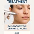 Mole Removal Treatment Derma One Clinic