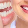Miami Cosmetic Dentistry For Professional Teeth Whitening