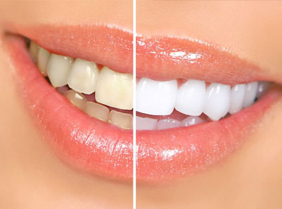 Miami, Health, Miami Cosmetic Dentistry For Professional Teeth Whitening