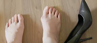 Singapore, Health, Bunion Treatment: Surgery Vs. Conservative Approaches