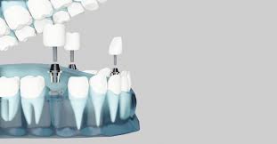 Singapore, Dental, Achieving Perfect Smiles: A Journey Through Dental Implants