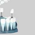 Achieving Perfect Smiles: A Journey Through Dental Implants