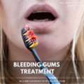 Bleeding Gums Treatment In Allen, TX