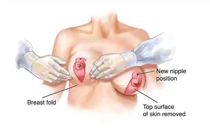 New Delhi, Health, Breast Lift Surgery Techniques Compared: What Works Best?