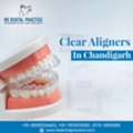 Clear Aligners In Chandigarh For Invisible Teeth Straightening