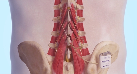 Sydney, Health, Multifidus Muscle | Mainstay Medical