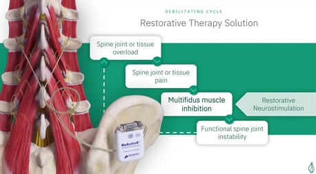 Sydney, Health, Multifidus Muscle | Mainstay Medical