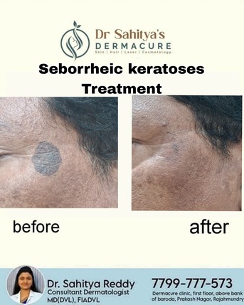 Kurnool, Health, Best Seborrheic Keratosis Treatment In Rajahmundry