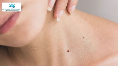 New York, Health, Milia Removal Near You &ndash; Gentle & Effective Skin Treatment