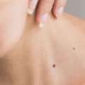 Milia Removal Near You &ndash; Gentle & Effective Skin Treatment