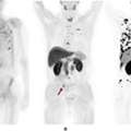 PSMA PET CT Scan For Prostate Cancer Detection - Picture This