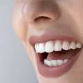 Tooth Color Fillings In Auckland