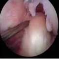 Exceed Expectations: ACL Surgery Options In Singapore