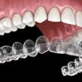 Invisalign In Toronto For Confident Smile - Consult Today