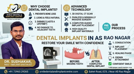 Hyderabad, Dental, BEST DENTAL IMPLANTS IN AS RAO NAGAR &ndash; PERMANENT TOOTH REPLACEMENT