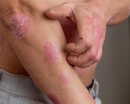 Ahmedabad, Health, SRIMAYAM AYURVED - Psoriasis Treatment In Gujarat