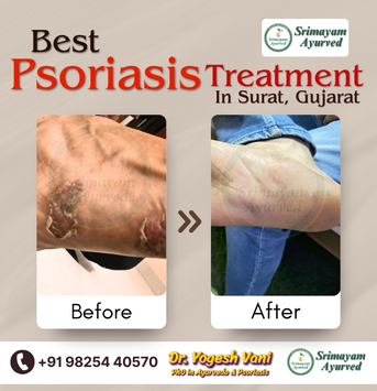 Ahmedabad, Health, SRIMAYAM AYURVED - Psoriasis Treatment In Gujarat