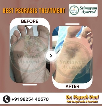 Ahmedabad, Health, SRIMAYAM AYURVED - Psoriasis Treatment In Gujarat