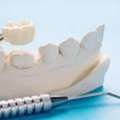 Keep Smiling: The Fascinating World Of Dental Fillings