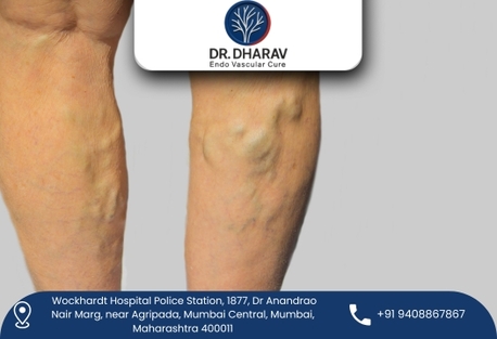 Mumbai, Health, Minimally Invasive Vein Disorder Treatment In India By Dr. Dharav Kheradia