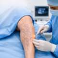 Varicose Veins Surgery In Baner - The Aesthetic Hub