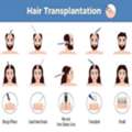 Hair Transplant Clinic In Pune | Natural Results At Arnica Clinic