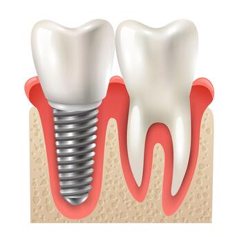 New York, Health, All-on-4 Dental Implants &ndash; Full Smile Restoration By Experts