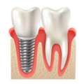 All-on-4 Dental Implants &ndash; Full Smile Restoration By Experts