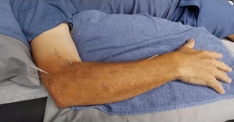Sydney, Health, Dry Needling Near Me &ndash; Reduce Pain & Muscle Tension | Strength Clinic