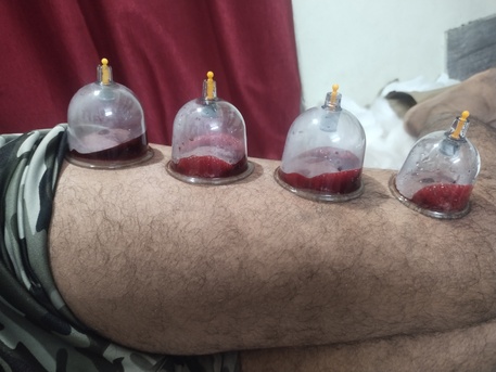 Kerala, Health, Hijama (Cupping )Therapy  Home Service.