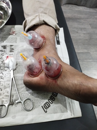 Kerala, Health, Hijama (Cupping )Therapy  Home Service.