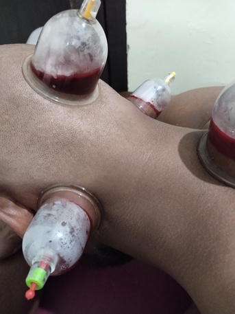 Mumbai, Health, Looking Hijama Cupping Job