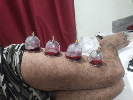 Mumbai, Health, Looking Hijama Cupping Job